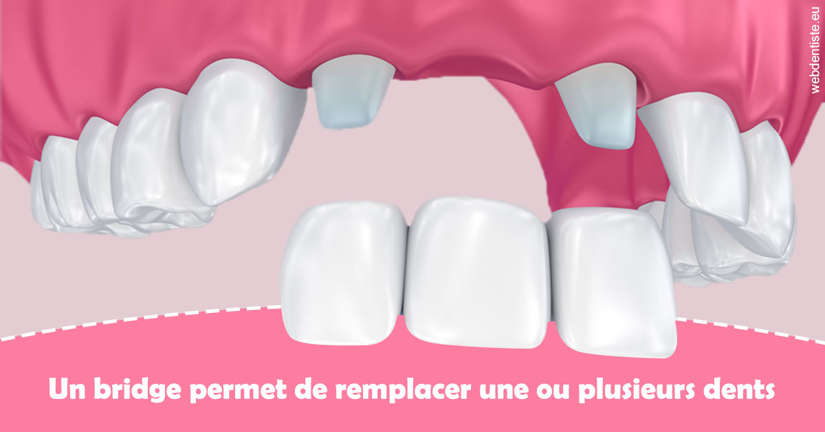 https://selarl-de-pape-romain.chirurgiens-dentistes.fr/Bridge remplacer dents 2