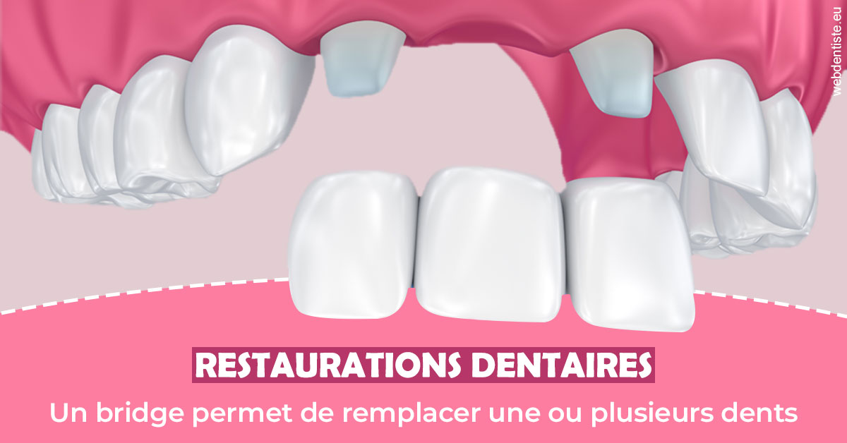 https://selarl-de-pape-romain.chirurgiens-dentistes.fr/Bridge remplacer dents 2
