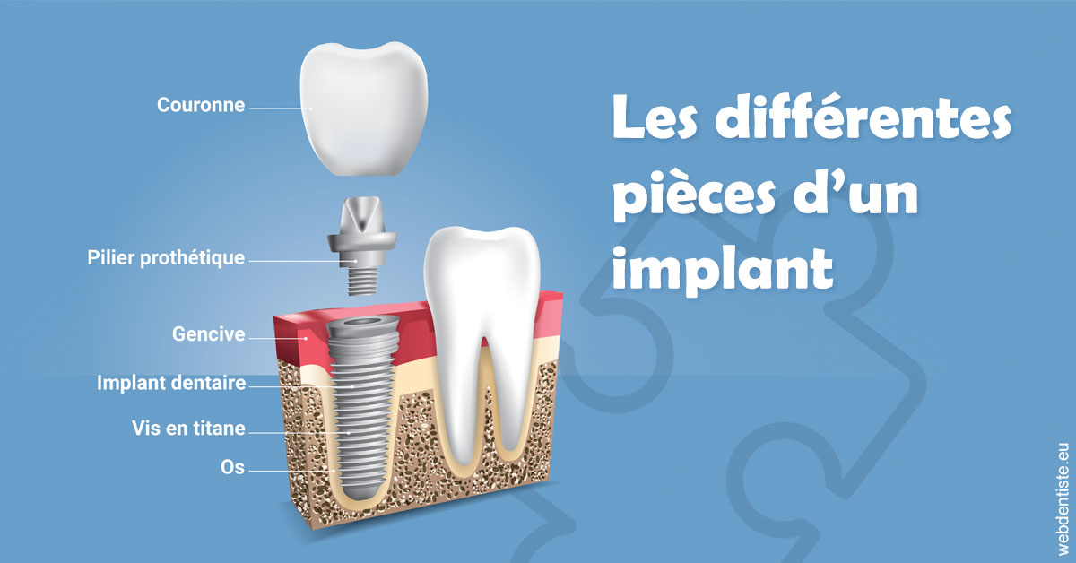 https://selarl-de-pape-romain.chirurgiens-dentistes.fr/Les différentes pièces d’un implant 1