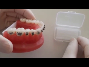 Comment mettre de la cire orthodontique?